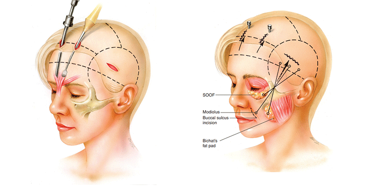 Lifting endoscopique du visage moyen en Turquie